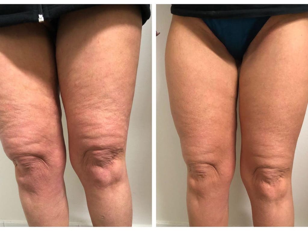Antes e depois de drenagem para lipedema